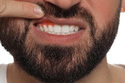 Inflamed Gums Man