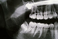 Xray Third Molars