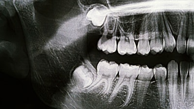 Xray Third Molars