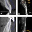 Illustration of the ABL measurement (red lines) on CBCT and ultrasound images of the (A, B) maxillary and (C, D) mandibular central incisors. The ultrasound images (B, D) correspond to the enclosures (blue-dashed rectangles) and in CBCT images (A, C) of the same teeth with the identified cementoenamel junction and alveolar bone crest. Images courtesy of Le et al. Licensed by CC BY 4.0.