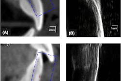 Illustration of the ABL measurement (red lines) on CBCT and ultrasound images of the (A, B) maxillary and (C, D) mandibular central incisors. The ultrasound images (B, D) correspond to the enclosures (blue-dashed rectangles) and in CBCT images (A, C) of the same teeth with the identified cementoenamel junction and alveolar bone crest. Images courtesy of Le et al. Licensed by CC BY 4.0.