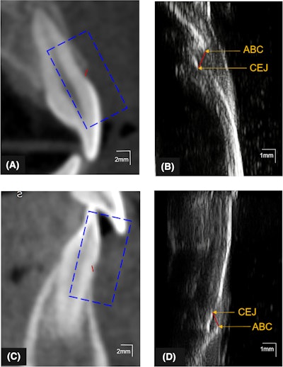 Illustration of the ABL measurement (red lines) on CBCT and ultrasound images of the (A, B) maxillary and (C, D) mandibular central incisors. The ultrasound images (B, D) correspond to the enclosures (blue-dashed rectangles) and in CBCT images (A, C) of the same teeth with the identified cementoenamel junction and alveolar bone crest. Images courtesy of Le et al. Licensed by CC BY 4.0.