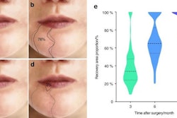 The sensation of the lower lip gradually recovered after inferior alveolar nerve sacrifice. (a) Sensory disturbance area diagram of the lower lip one month after operation. (b) Sensory disturbance area diagram of the lower lip three months after operation. (c) Sensory disturbance area diagram of the lower lip six months after operation. (d) Sensory disturbance area diagram of the lower lip one year after operation. (e) The proportion of lower lip sensory recovery area at three, six, and 12 months after surgery based on the area with lower lip sensory disturbance at one month after surgery. Licensed by CC BY-NC-ND. Image courtesy of the International Journal of Oral Science.