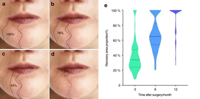 Rectangular Lower Lip Lower lip sensation loss after mandibulectomy may not be irreversible ...