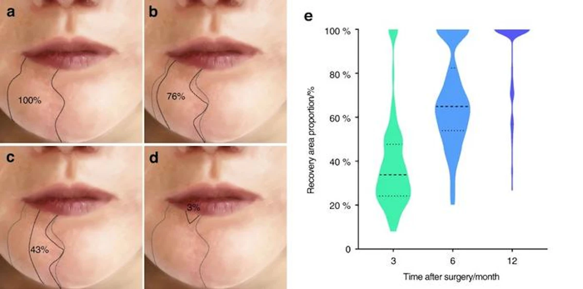 Lower lip sensation loss after mandibulectomy may not be irreversible ...