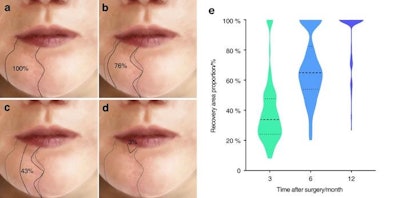 The sensation of the lower lip gradually recovered after inferior alveolar nerve sacrifice. (a) Sensory disturbance area diagram of the lower lip one month after operation. (b) Sensory disturbance area diagram of the lower lip three months after operation. (c) Sensory disturbance area diagram of the lower lip six months after operation. (d) Sensory disturbance area diagram of the lower lip one year after operation. (e) The proportion of lower lip sensory recovery area at three, six, and 12 months after surgery based on the area with lower lip sensory disturbance at one month after surgery. Licensed by CC BY-NC-ND. Image courtesy of the International Journal of Oral Science.