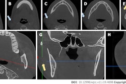 Coronal views of CBCT scans (A-E) show swelling. The CBCT scan shows an air-filled fissure between the masseter muscle and soft tissue (F-H) . The blue arrows indicate swelling, while the yellow arrows indicate the fissure. Images courtesy of Sun et al. Licensed by CC BY 4.0.
