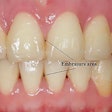 Measurement of areas of open gingival embrasures. Image courtesy of Li et al. Licensed by CC BY 4.0.