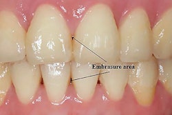 Measurement of areas of open gingival embrasures. Image courtesy of Li et al. Licensed by CC BY 4.0.