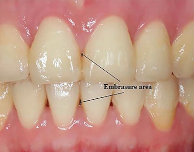 Measurement of areas of open gingival embrasures. Image courtesy of Li et al. Licensed by CC BY 4.0.