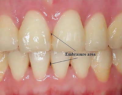 American Academy of Clear Aligners - Some Clear Aligner Systems