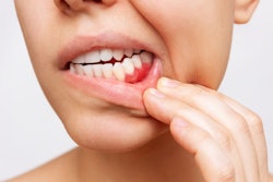 Gum Inflammation