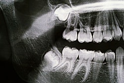 Xray Third Molars