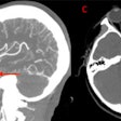 (A) and (B) Coronal and sagittal view of the CT angiogram shows the wire penetrating through the skull floor of a 12-year-old boy. (C) Axial view of CT demonstrates the wire in the temporal lobe and the associated intraparenchymal hemorrhage. (D) Axial bone window CT shows the wire entering through the foramen ovale.