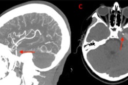 (A) and (B) Coronal and sagittal view of the CT angiogram shows the wire penetrating through the skull floor of a 12-year-old boy. (C) Axial view of CT demonstrates the wire in the temporal lobe and the associated intraparenchymal hemorrhage. (D) Axial bone window CT shows the wire entering through the foramen ovale.