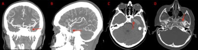 (A) and (B) Coronal and sagittal view of the CT angiogram shows the wire penetrating through the skull floor of a 12-year-old boy. (C) Axial view of CT demonstrates the wire in the temporal lobe and the associated intraparenchymal hemorrhage. (D) Axial bone window CT shows the wire entering through the foramen ovale.