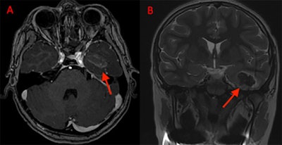 (A) Axial MRI with contrast shows residual hematoma within the temporal lobe two days after removal. (B) Coronal MRI without contrast also shows temporal lobe hematoma.