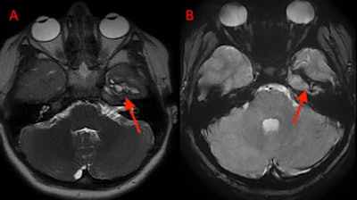 (A) An axial T2 SSFSE and (B) an axial T2 GRE MRI at two-month follow-up shows the collapsed porencephalic defect in the left temporal lobe.