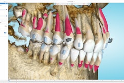 The TruRoot CBCT collision alert system, which is a new feature of the Spark clear aligners release 14. Image courtesy of Ormco.