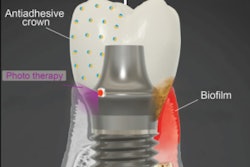 The smart implant. Image courtesy of Penn Dental Medicine.