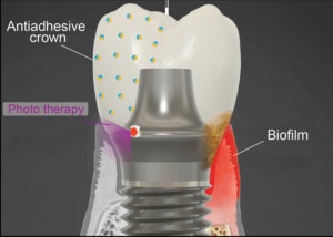 The smart implant. Image courtesy of Penn Dental Medicine.