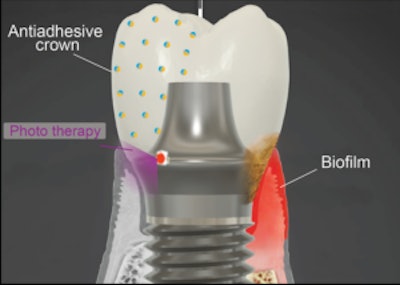 The smart implant. Image courtesy of Penn Dental Medicine.
