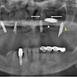 The panoramic x-ray of a 51-year-old woman. The white arrow indicates the left hard palate line, while the yellow arrow indicates the antral floor. The implant fixture is displaced into the superior cavity, but the bone between the white arrows appears to have sufficient volume. All images courtesy of Kim et al. Licensed by CC BY 4.0.