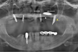 The panoramic x-ray of a 51-year-old woman. The white arrow indicates the left hard palate line, while the yellow arrow indicates the antral floor. The implant fixture is displaced into the superior cavity, but the bone between the white arrows appears to have sufficient volume. All images courtesy of Kim et al. Licensed by CC BY 4.0.
