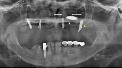 The panoramic x-ray of a 51-year-old woman. The white arrow indicates the left hard palate line, while the yellow arrow indicates the antral floor. The implant fixture is displaced into the superior cavity, but the bone between the white arrows appears to have sufficient volume. All images courtesy of Kim et al. Licensed by CC BY 4.0.