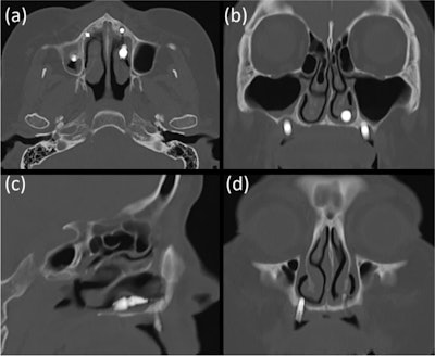 The CT image of the first patient shows that the implant was displaced in the left nasal cavity but not in the maxillary sinus (a-c). The implant of the right premolar area, which appeared to be placed in a spot with insufficient bone between the nasal cavity and the maxillary sinus on an x-ray, appears to penetrate the nasal floor.