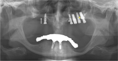 The panoramic x-ray of a 64-year-old man shows that perforation is suspected at the right maxillary sinus floor (white arrow). The white arrow indicates the left hard palate line, while the yellow arrow indicates the antral floor.
