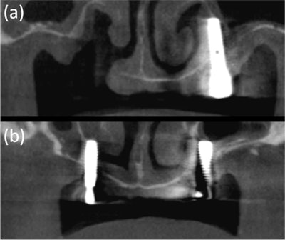 The 64-year-old's CBCT images showed a discontinuity of the inferolateral cortex of the nasal cavity and oronasal fistula, which is observed as a tissue defect on the x-ray. (a) Moreover, the residual implants on both sides perforated the nasal cavity and are placed just medial to the maxillary sinus.
