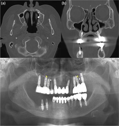 The x-ray and CT images of a 76-year-old woman. On the x-ray, white arrows indicate the hard palate line, while yellow arrows indicate the antral floor. Images of the implants in the left premolar and molar areas are superimposed above the hard palatal line. (b-c) The CT images revealed nasal floor perforation by an implant of the maxillary left premolar.
