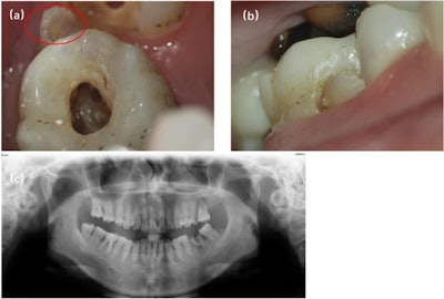 (a, b) Preoperative image showing occlusal and buccal planes of the protostylid in tooth #26. The red open circle indicates the protostylid. (c) A panoramic view of permanent teeth with normal anatomy. Images courtesy of Tao et al.