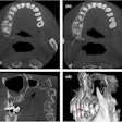 CBCT images (a, b) of the cross section of the plane of the protostylid in tooth #26. (c) The vertebral plane of the protostylid in tooth #26. (d) A 3D reconstruction of the protostylid in tooth #26. Red solid arrows indicate the protostylid.