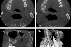 CBCT images (a, b) of the cross section of the plane of the protostylid in tooth #26. (c) The vertebral plane of the protostylid in tooth #26. (d) A 3D reconstruction of the protostylid in tooth #26. Red solid arrows indicate the protostylid.
