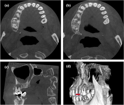CBCT images (a, b) of the cross section of the plane of the protostylid in tooth #26. (c) The vertebral plane of the protostylid in tooth #26. (d) A 3D reconstruction of the protostylid in tooth #26. Red solid arrows indicate the protostylid.