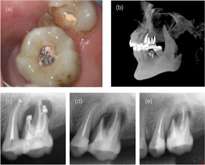 Immediate postoperative and follow-up imaging. (a) The filled root canal under an operating microscope. (b) A 3D reconstruction of filled tooth #26. (c) A periapical radiograph taken after treatment. (d) A radiograph taken at the six-month follow-up. (e) A radiograph taken one year after the root canal.
