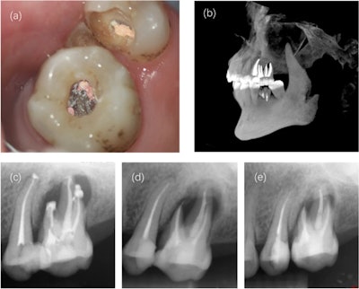 3D Image and Root Canal Procedure - Center 4 Smiles