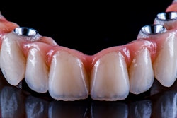Arch Bridge Implant