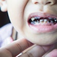 Child Caries Tooth Decay