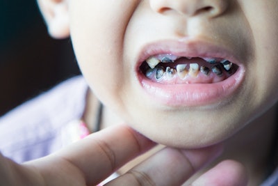 Child Caries Tooth Decay