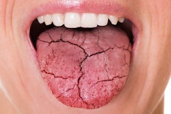 Dry Mouth Cracked Toungue