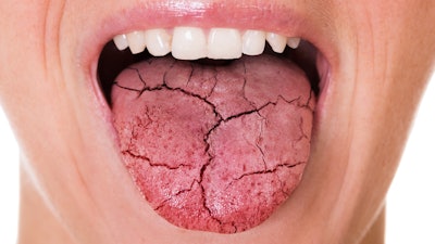 Dry Mouth Cracked Toungue