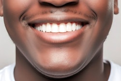 Veneers Man