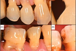 A 66-year-old man who received periodontal therapy two to three times annually presented at the dental office with buccal and interproximal tooth substance loss due to interdental brushing with medium- to high-abrasive toothpastes. Images courtesy of Schmidlin et al. Licensed by CC BY 4.0.