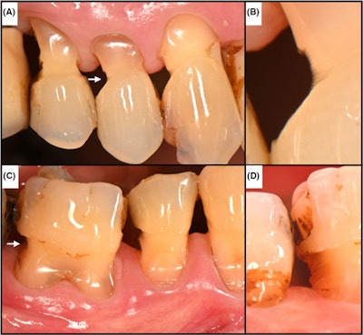 A 66-year-old man who received periodontal therapy two to three times annually presented at the dental office with buccal and interproximal tooth substance loss due to interdental brushing with medium- to high-abrasive toothpastes. Images courtesy of Schmidlin et al. Licensed by CC BY 4.0.