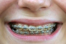 Braces