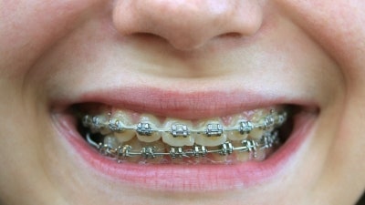 Braces