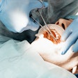 Dental Implant Placement